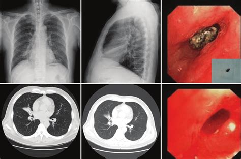 Posterior‑anterior A And Lateral B Chest Radiographs Showed Right