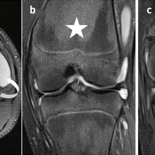 12-year-old with primary hypertrophic osteoarthropathy. (a) Axial fat ...