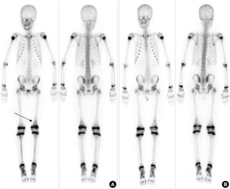 Initial Whole Body Bone Scan Showed Mild Increased Uptake In The Left