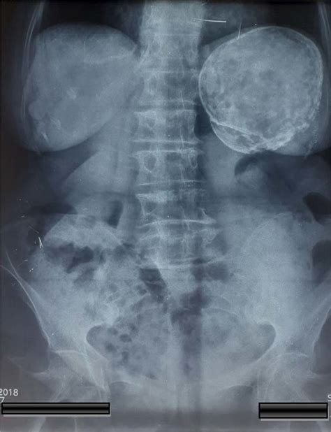 Abdominal X Rays With A Calcified Cyst At The Left Upper Quadrant Of Download Scientific