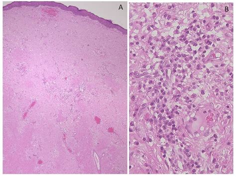 Nodular Amyloidosis In A Patient With Liver Cirrhosis