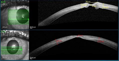 As Oct Evaluation Of Corneal Ulcer Preoperative Superior Figure And