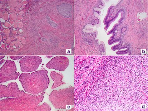 A Brenner Tumor B Mucinous Cystadenoma Showing Focal Atypia C Serous