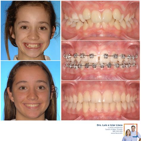 Brackets De Alta Tecnolog A Llaca Ortodoncia Oviedo