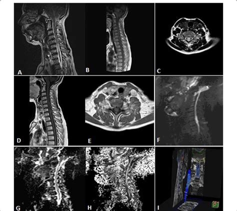 A Years Old Female Patient Presented With Progressive Quadriparesis