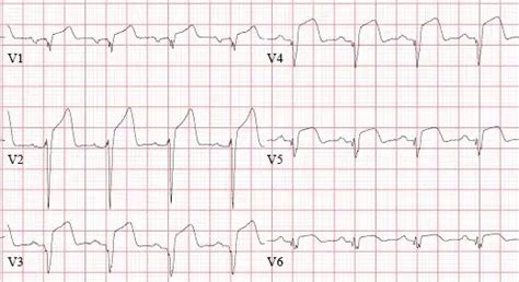 Anterior Myocardial Infarction • Litfl • Ecg Library