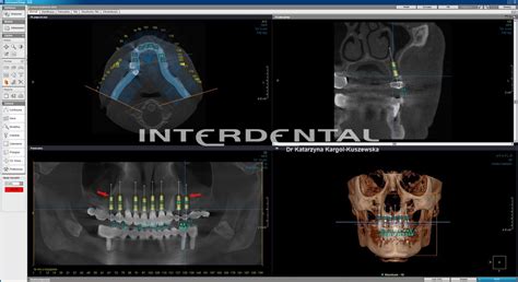 CBCT Tomografia Komputerowa W Stomatologii Radiologia Cyfrowa