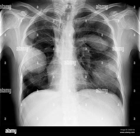 Secondary Lung Cancers X Ray These Cancers Have Spread Metastatised To The Lungs From