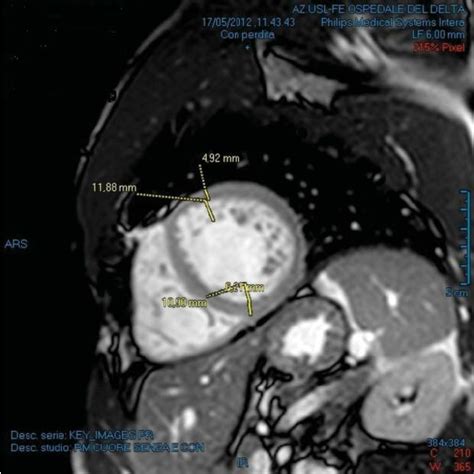 Cardiac Magnetic Resonance Cmr Shows A Four Chamber End Dias Tolic