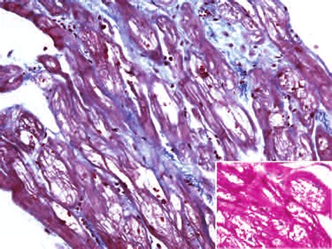 Endomyocardial Biopsy From The Left Ventricle Light Microscopy