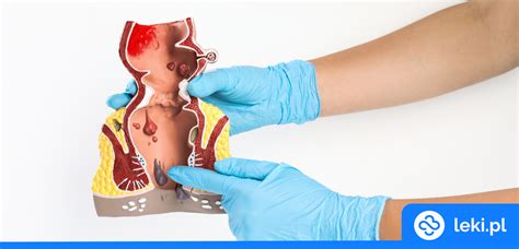 Co stosować na zewnętrzne hemoroidy leki pl