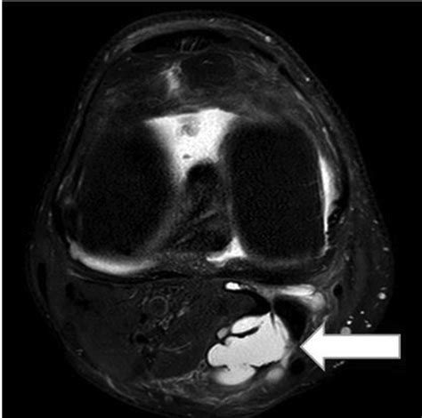 Possible Approaches To Endoscopic Treatment Of Popliteal Cysts From