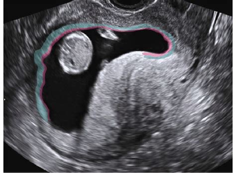 Ultrasound Image Showing The Relationship Between The Smooth Chorion