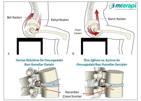 Kanal Darlığı Nedir Belirtileri Tedavisi Kadıköy Fizik Tedavi