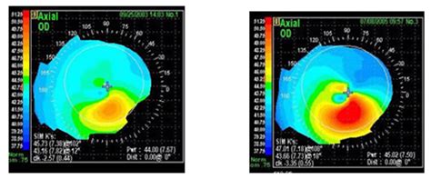 Treatment Of Keratoconus By Collagen Cross Linking With Riboflavin C R