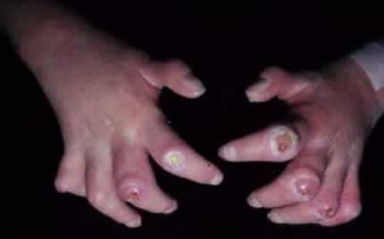 Scleroderma Pictures