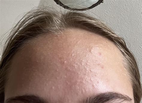 [acne] Closed Comedones Fungal Acne R Skincareaddiction