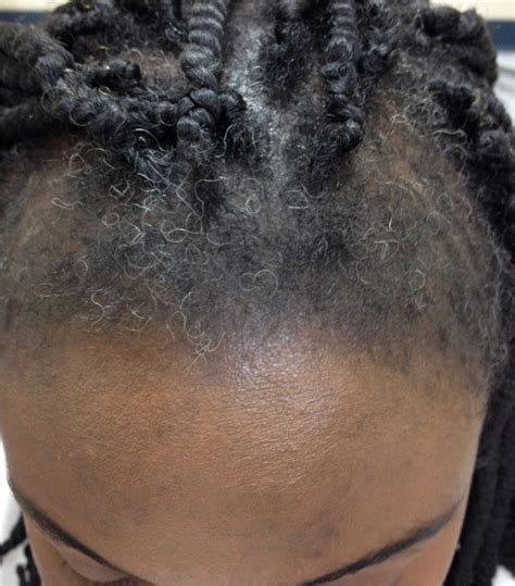 Traction Alopecia: How to Reverse It? Causes and Treatment - Hairverse