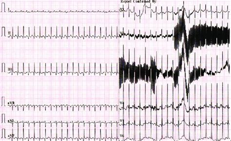 The 12-lead electrocardiogram showing a regular narrow QRS tachycardia ...