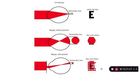 Visual Acuity In Refraction And Refractive Error Youtube