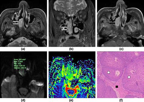 Differentiation Between Atypical Sinonasal Non Hodgkins Lymphoma And Inverted Papilloma