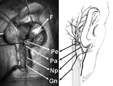 Left Intraoperative View Of The Neurovascular Pedicle Postauricular