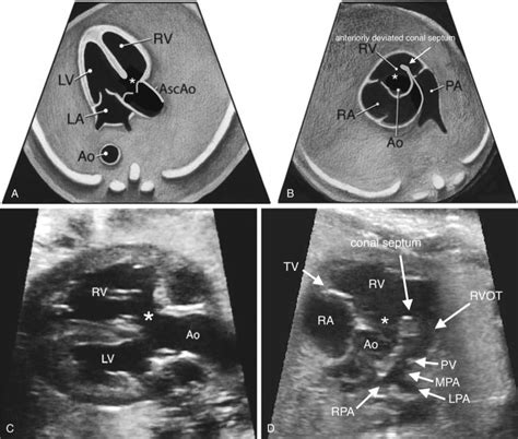 Sonographic Evaluation Of The Fetal Heart Radiology Key