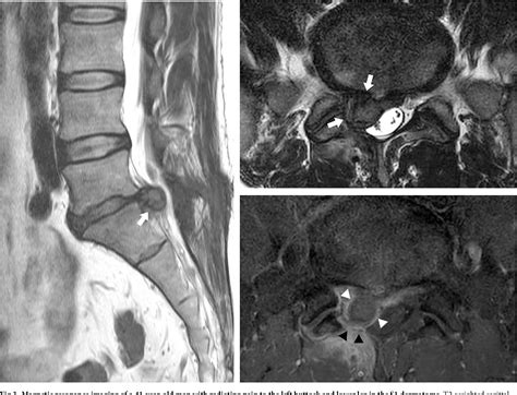 Figure 3 From Fluoroscopic Lumbar Transforaminal Epidural Steroid