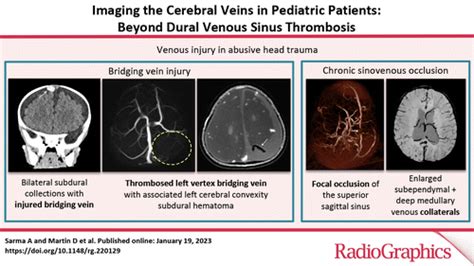 Imaging The Cerebral Veins In Pediatric Patients Beyond Dural Venous