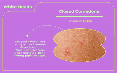 Serupa Tapi Tak Sama Perbedaan Fungal Acne Komedo Putih Dan Milia