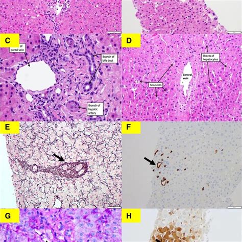 Histopathological Features Of Intrahepatic Cholangiocarcinoma Icc