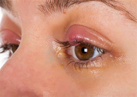 Causes Treatments And Prevention For Swollen Eyelids