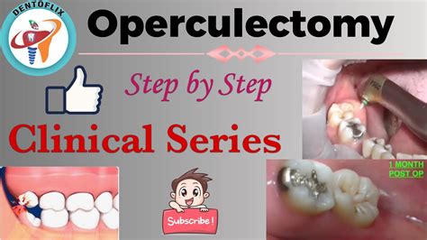 Operculectomy Step By Step Clinical Series Youtube