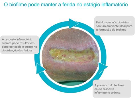 Infecção e Biofilme