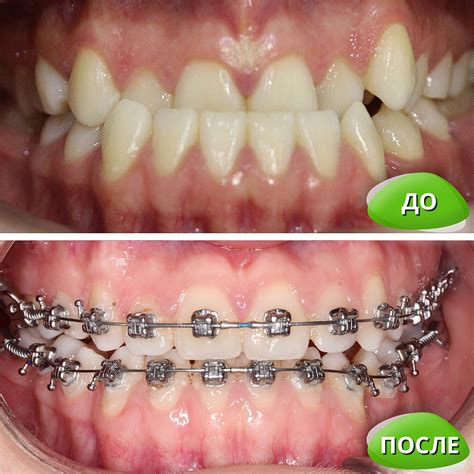 Orthodontics Metal Braces Invisalign Artofit