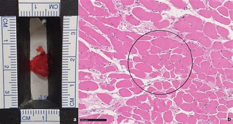 Macroscopic A And Histological B View Magnification Of