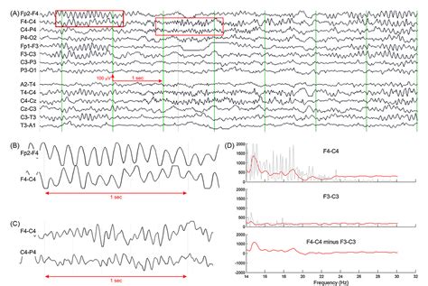 Figure From Paroxysmal Fast Activity An Interictal Scalp Eeg Marker