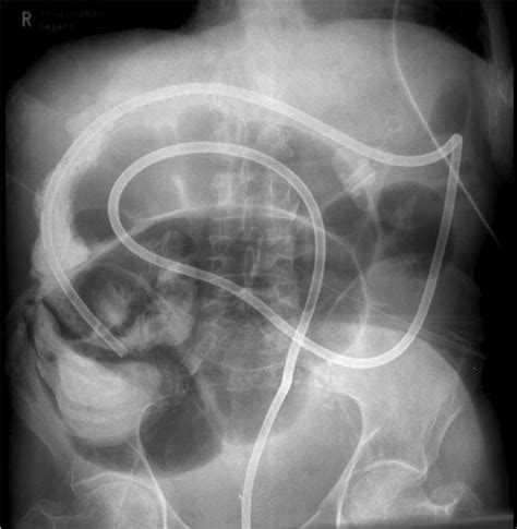 Colonic Stenting Still A Challenge Gastroenterologen