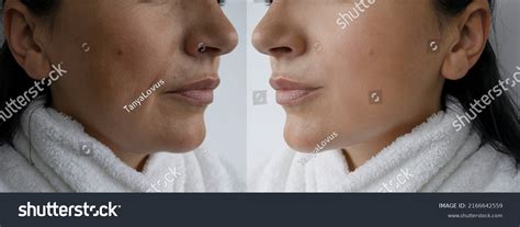 Woman Double Chin Before After Treatment Stock Photo 2166642559 ...