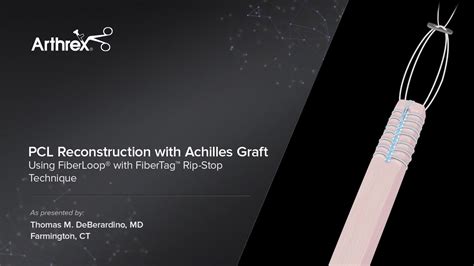 Arthrex Pcl Reconstruction With Achilles Graft Using Fiberloop With