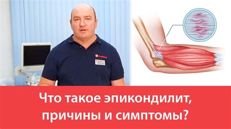 Что такое эпикондилит, причины и симптомы? - YouTube