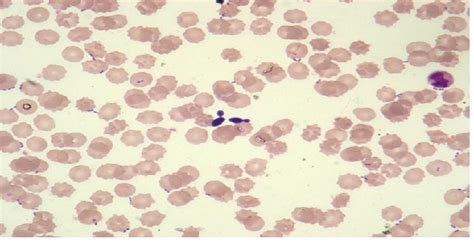 VETERINARY HEMATOLOGY DEXTERVET: Candidemia that is a bloodstream ...
