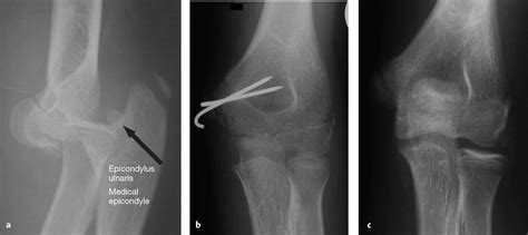 Tratamiento De La Lesión Por Avulsión Apofisaria De La Epitróclea En