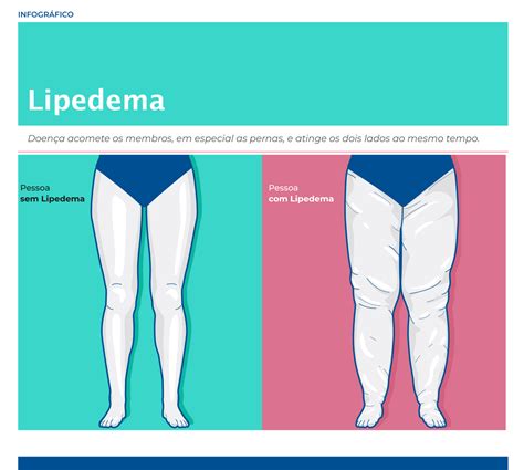 Saiba O Que é Lipedema Doença Confundida Com A Obesidade • Papo No