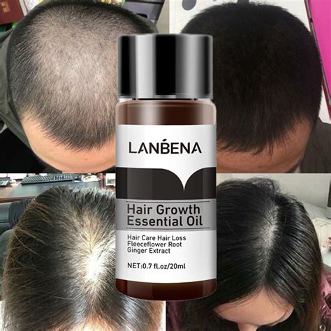 Lanbena Hair Growth Essential Oil Hair Loss Treatment Prevent Baldness