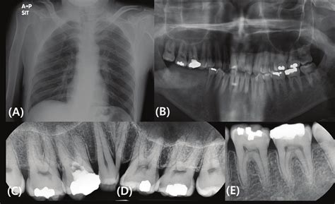 A Posteroanterior Pa Chest And Dental Radiographs Of The Patient A