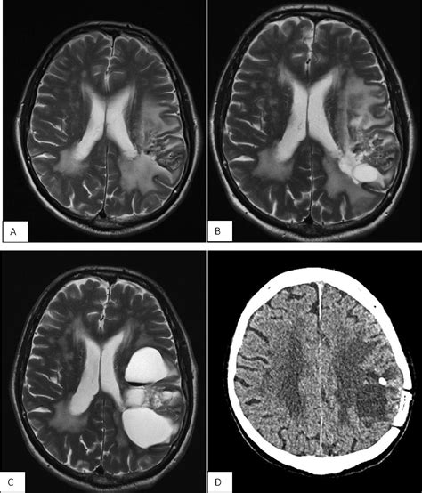 A Case Of Delayed Cyst Formation Post Brain Avm Stereotactic Radiosurgery For Arteriovenous