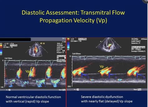 Fluss Propagation Ein Parameter Zur Evaluation Diastolischen Funktion