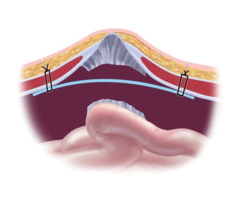 Hernia Types Ventral California Hernia Specialists