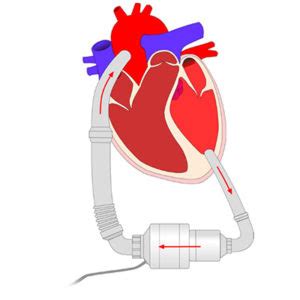 Left Ventricular Heart Assist Device (LVAD) - Allied Motion